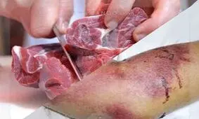 بهبودی کامل 3نفر مبتلا به بیماری تب خونریزی دهنده کنگو در استان کرمانشاه