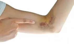 پنج دلیل احتمالیِ کبودی در بدن/ اینفوگرافیک 