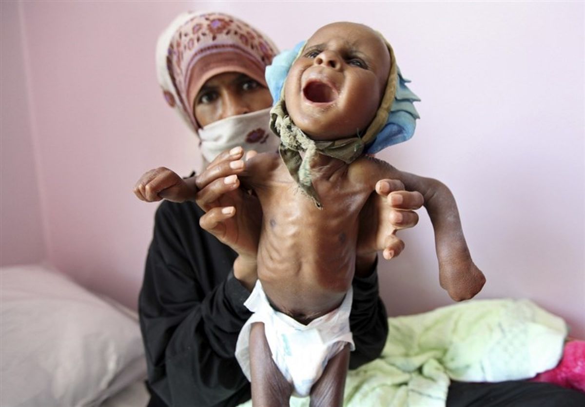یونیسف: یک‌میلیون و ۸۰۰هزار کودک یمنی از سوء‌تغذیه شدید رنج می‌برند