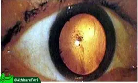 این دختر جن یا هیولا نیست/ تاثیر دیدن انفجار بمب اتمی