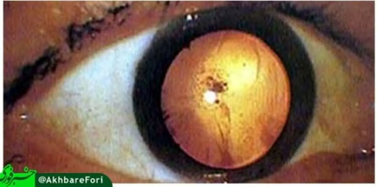 این دختر جن یا هیولا نیست/ تاثیر دیدن انفجار بمب اتمی