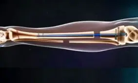 فیلم/ نحوه‌ عمل جراحی افزایش قد