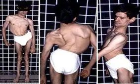 فیلم/ دیستروفی چیست؟ یک بیماری خطرناک که دولت ریالی برای بیمارانش هزینه نمی‌کند