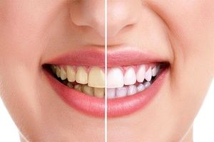 راهکارهای طبیعی برای خلاصی از جرم دندان