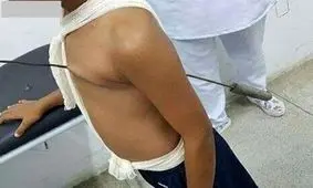 خارج کردن سیخ کباب از بدن پسربچه‎ +عکس