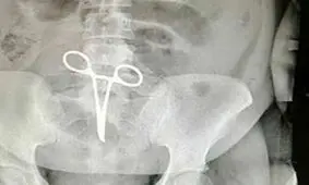 عذرخواهی رییس بیمارستان به دلیل جا ماندن قیچی در شکم بیمار