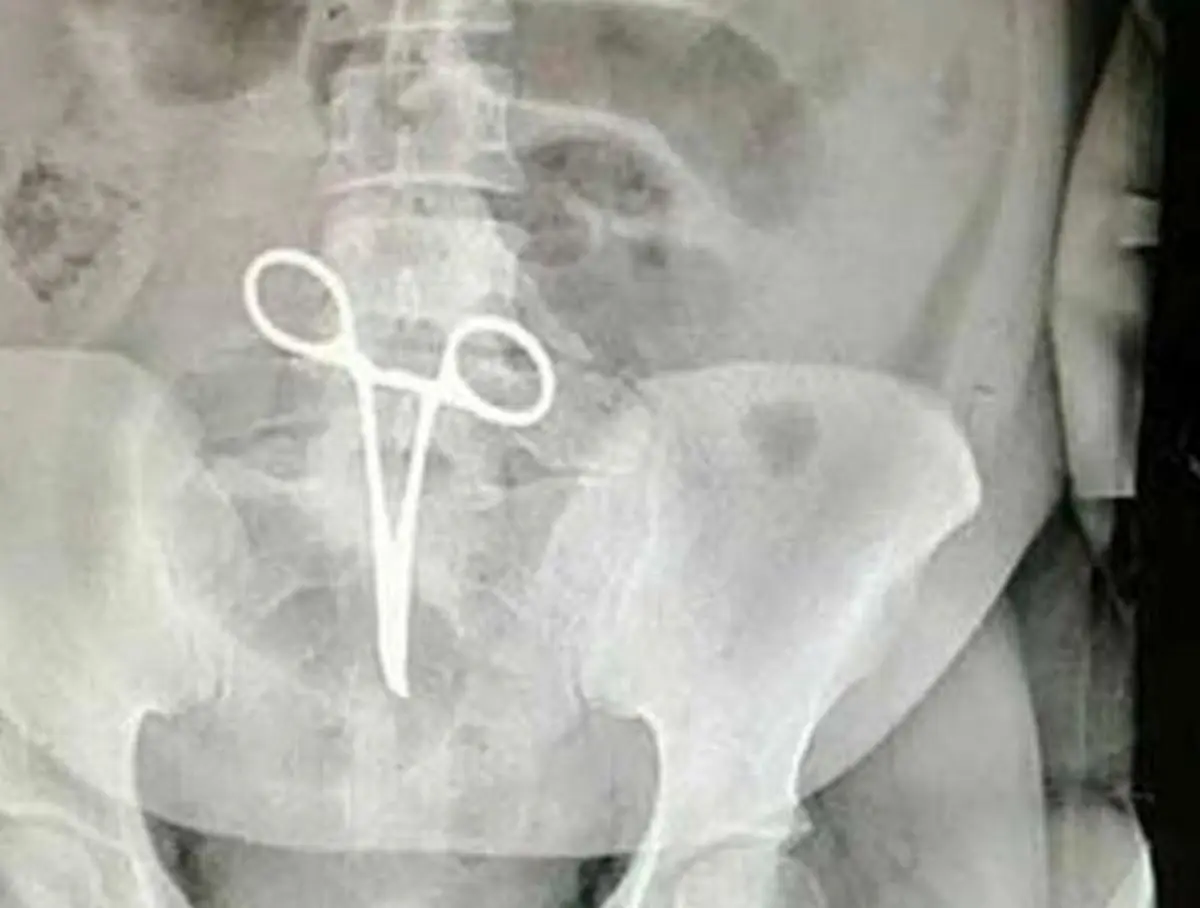 عذرخواهی رییس بیمارستان به دلیل جا ماندن قیچی در شکم بیمار