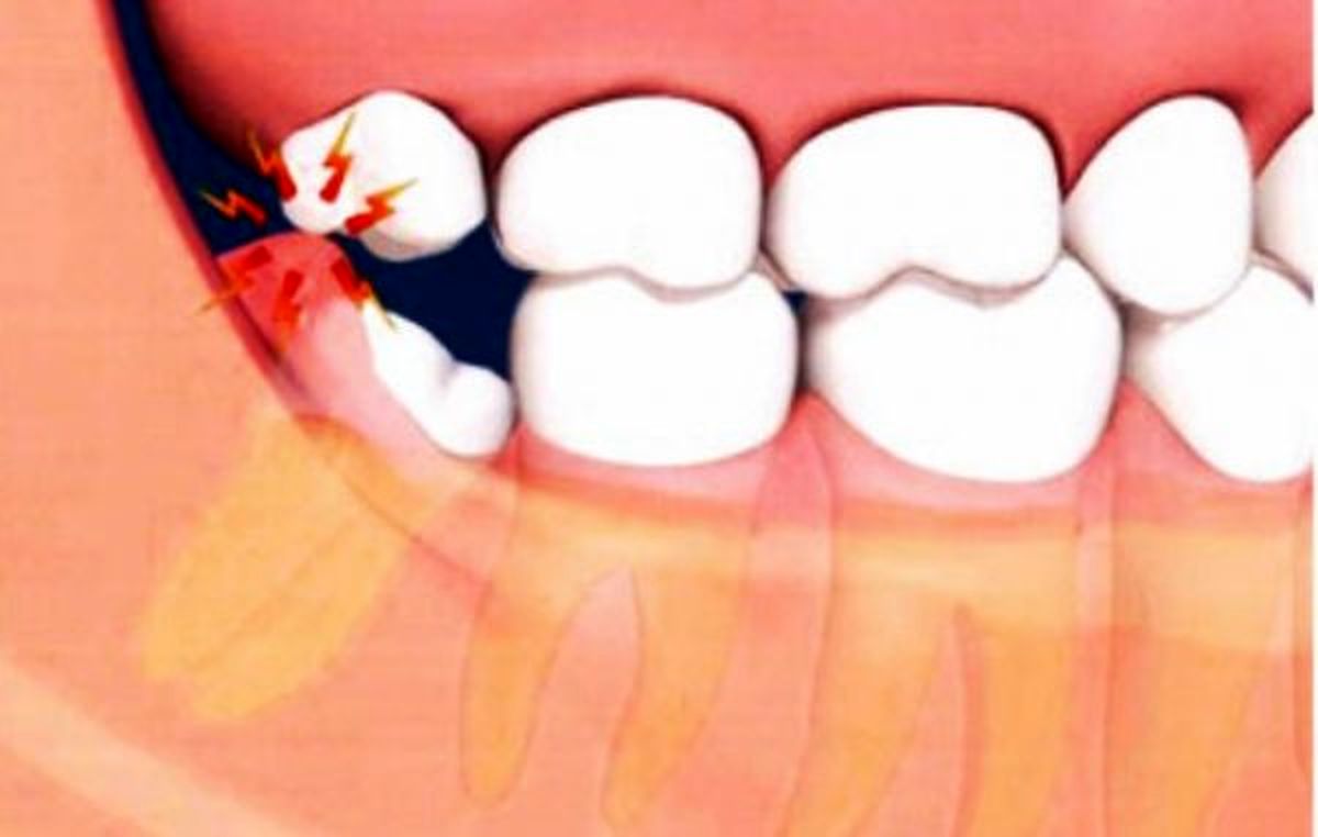 بهترین سن جراحی دندان عقل چند سالگی است؟