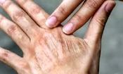 چگونه از خشکی پوست در پاییز جلوگیری کنیم؟
