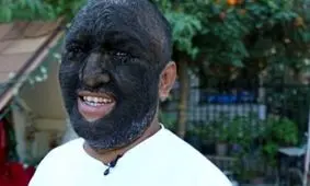 «مرد گرگی» که ۹۸ درصد بدنش را مو پوشانده است+ تصاویر