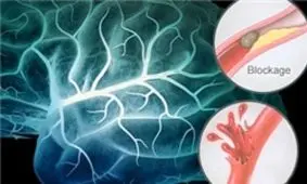 سکته مغزی دومین علت مرگ ایرانیان