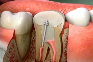 علت درد دندان عصب کشی شده بعد از چند سال چیست؟
