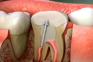 علت درد دندان عصب کشی شده بعد از چند سال چیست؟