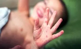 شیوع سرخک در اروپا