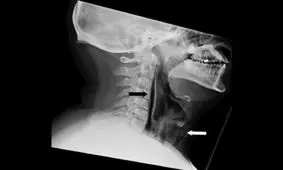 هرگز جلوی عطسه‌تان را نگیرید، ممکن است گلویتان سوراخ شود