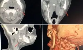 جراحی خارج کردن جسم از گردن