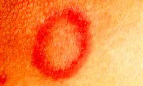 روش‌های خانگی درمان قارچ پوستی