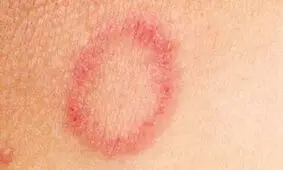 روش‌های خانگی درمان قارچ پوستی