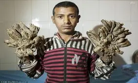 شاخ و برگ «مرد درختی» قطع شد+ عکس