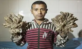شاخ و برگ «مرد درختی» قطع شد+ عکس