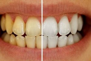 راهکارهای طلایی برای سفید کردن دندان‌ها