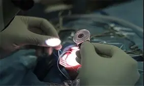 هزینه کاشت حلزون ۱۳ مددجوی بهزیستی در استان کرمانشاه تامین شد