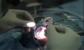 هزینه کاشت حلزون ۱۳ مددجوی بهزیستی در استان کرمانشاه تامین شد