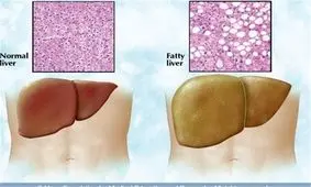 تاثیر کاهش سریع وزن و خواب بر افزایش "چربی کبد"