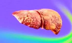 درمان کبد چرب با ساخت یک داروی جدید​