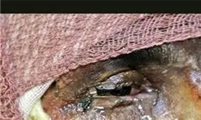 شایع‌ترین علت مرگ بیماران سوختگی ایران چیست