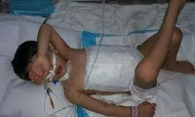 دریده شدن شکم کودک ۵ ساله توسط سگ