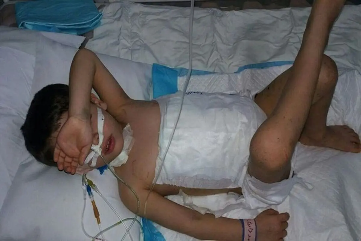 دریده شدن شکم کودک ۵ ساله توسط سگ