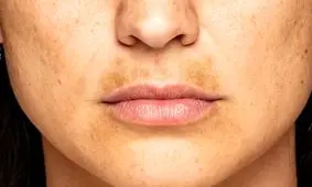 کدام غذاها باعث لک صورت می شوند؟