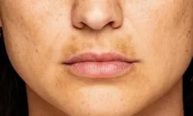 کدام غذاها باعث لک صورت می شوند؟
