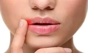 تبخال یا جوش؟ روش درست تشخیص و بهترین درمان!