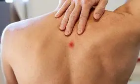 مراقب جوش های ناحیه کمر و پشت شانه های خود باشید