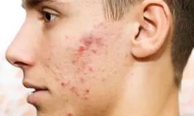 غذاهایی که باعث جوش صورت و آکنه میشود