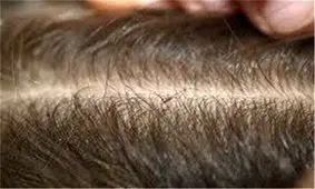 طرح غربالگری شپش سر در تمام مدارس، دانشگاه‌ها و زندان‌های استان کرمانشاه اجرا می‌شود