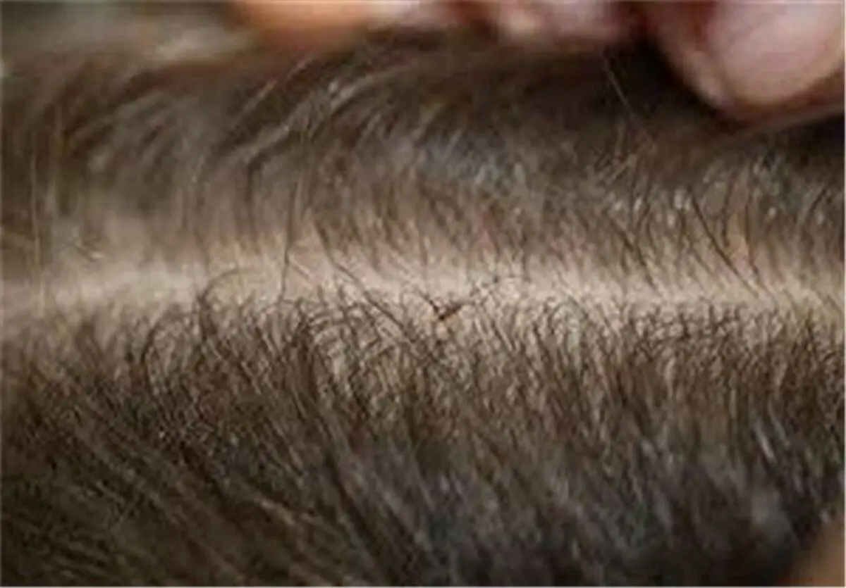 طرح غربالگری شپش سر در تمام مدارس، دانشگاه‌ها و زندان‌های استان کرمانشاه اجرا می‌شود