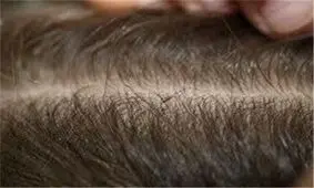 طرح غربالگری شپش سر در تمام مدارس، دانشگاه‌ها و زندان‌های استان کرمانشاه اجرا می‌شود