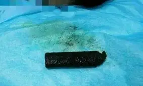 خارج کردن چراغ قوه از معده یک مرد! +عکس