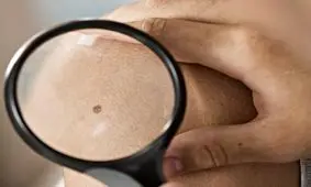 چهار علامت تبدیل خال به سرطان چیست؟