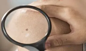 چهار علامت تبدیل خال به سرطان چیست؟