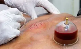 50 دردی که می‌توانید با حجامت تسکین دهید
