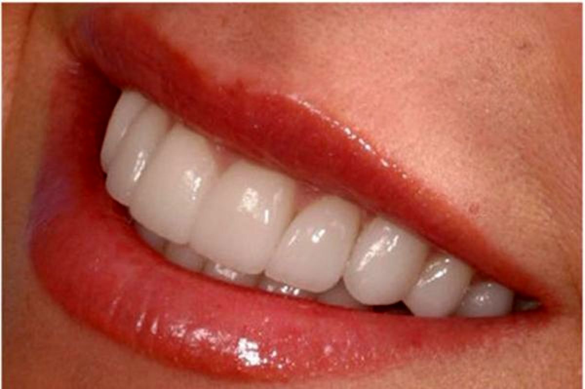 ساخت دندان مصنوعی که از عفونت دهان جلوگیری می کند