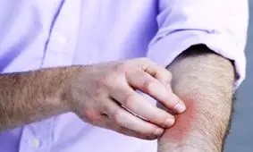 حجامت آلرژی؛ راه حلّی ساده برای مشکلی بزرگ