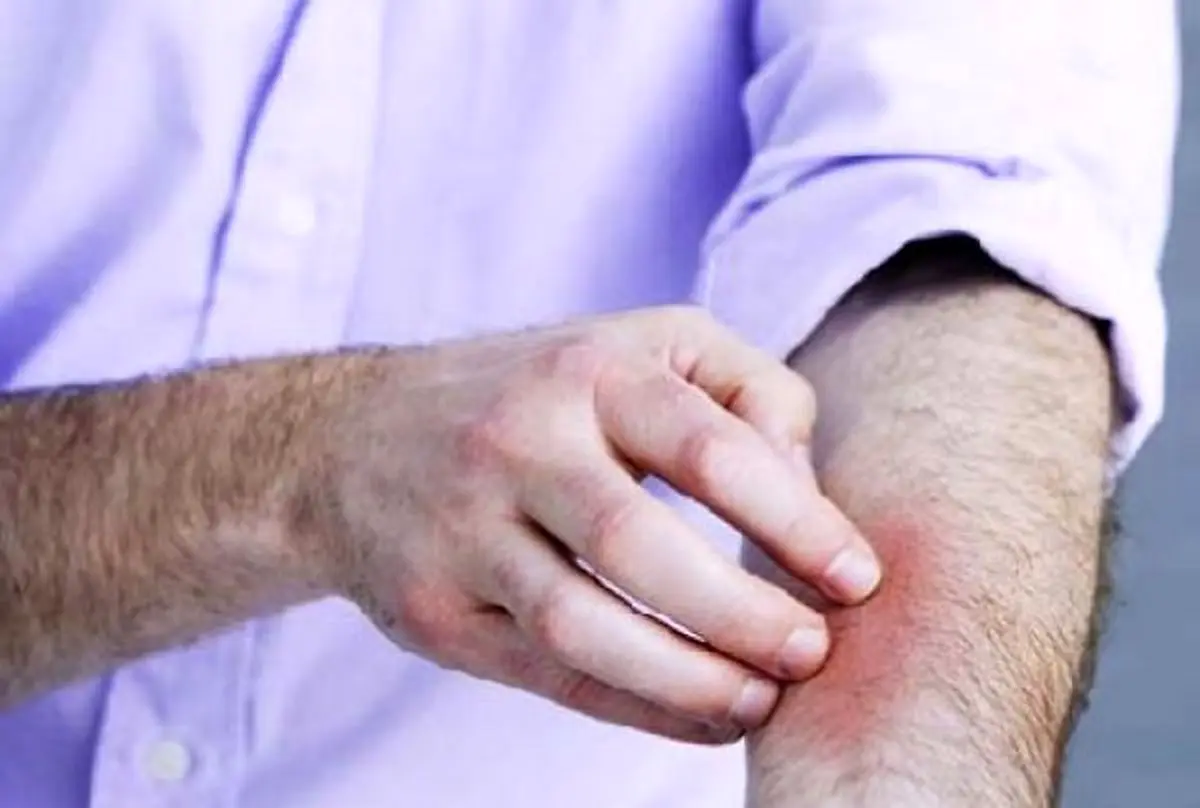 حجامت آلرژی؛ راه حلّی ساده برای مشکلی بزرگ