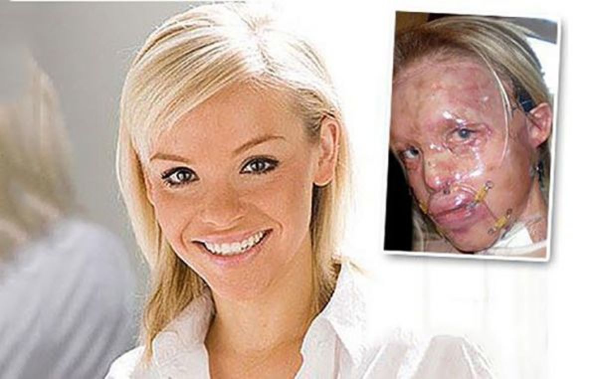 عکس قبل و بعد اسید پاشی به صورت خانم مجری تلویزیون