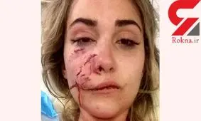 حمله سگ وحشی به خانم مدلینگ / صورت این دختر 19 بخیه خورد +عکس
