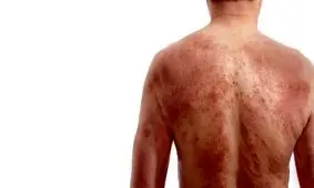 درباره سندرم درس (DRESS) چه می دانید؟/ از ایجاد تا درمان